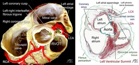 left ventricular summit